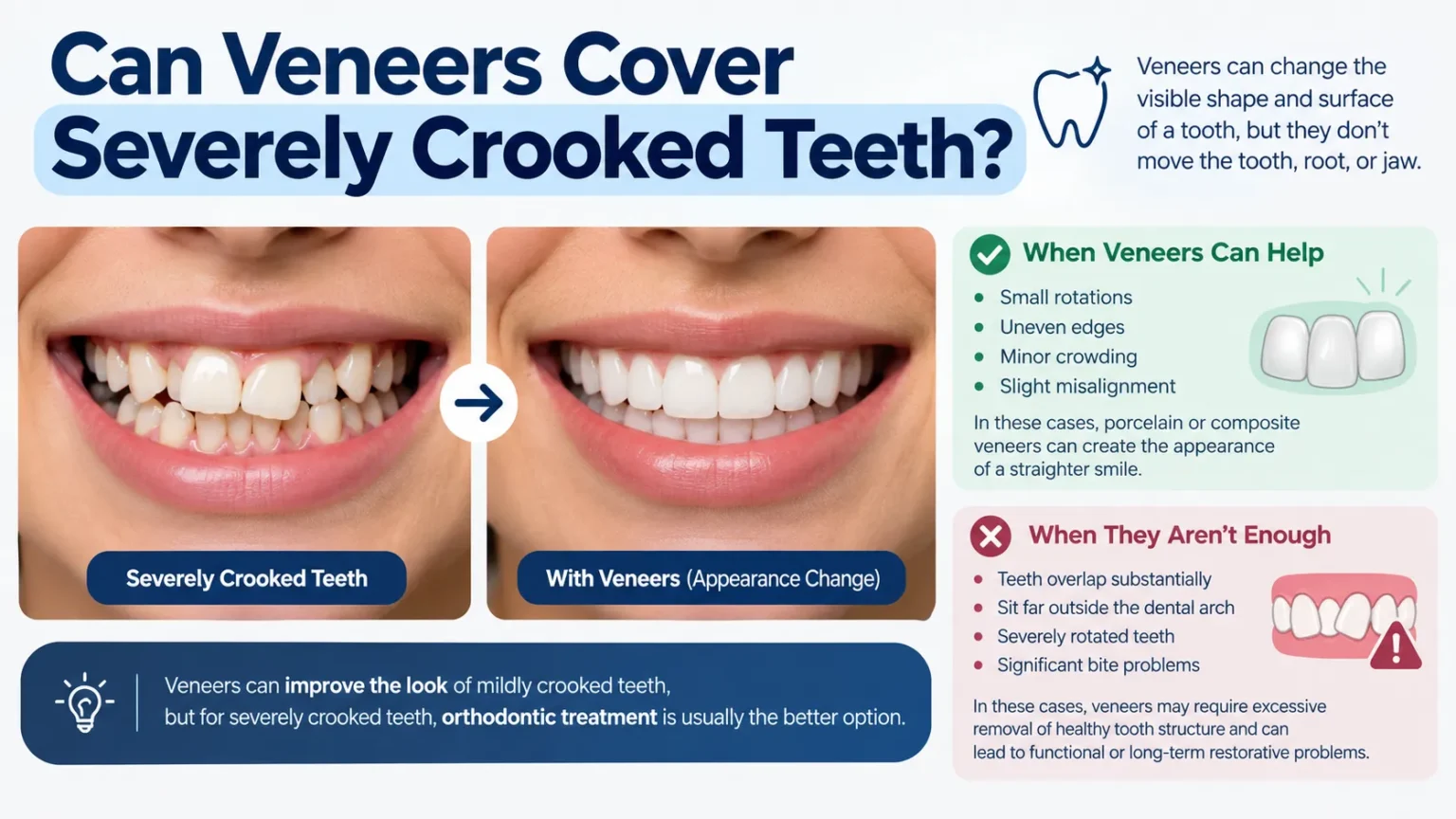 Can Veneers Cover Severely Crooked Teeth?
